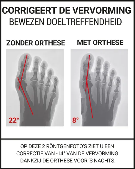 CORRIGERENDE HALLUX VALGUS ORTHESE MET DUBBELE WERKING